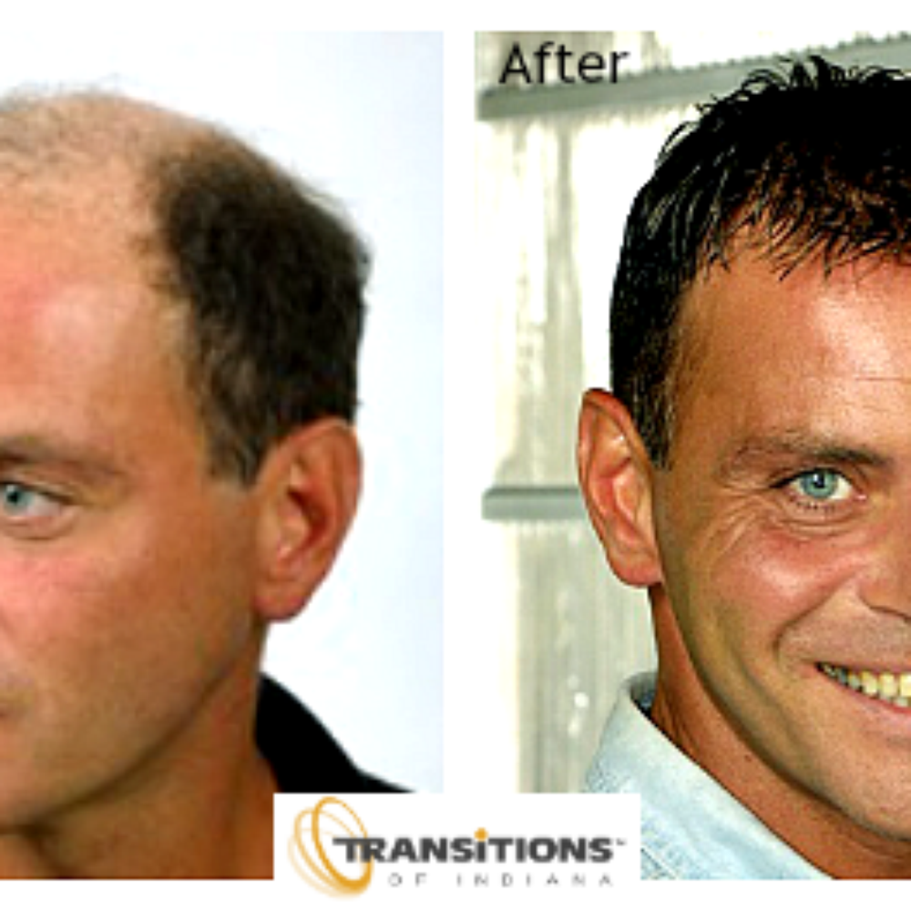 Hair Transplant Indianapolis Indiana