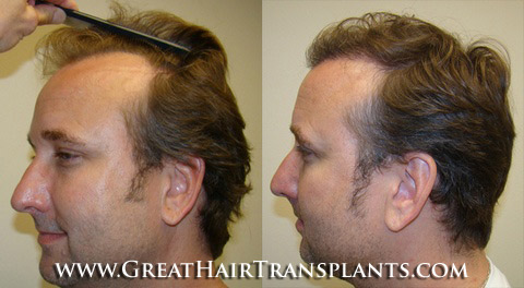 Hair Transplant Memphis Tennessee