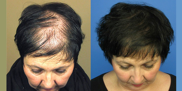 Hair Transplant Portland Oregon