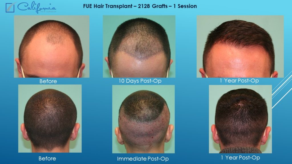 Hair Transplant San Jose California