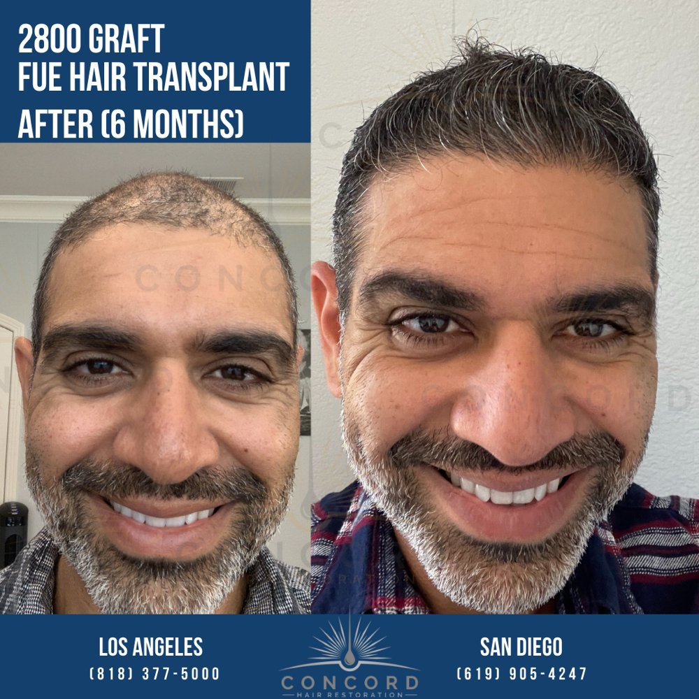 Hair Transplant Santa Ana California