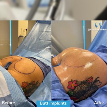 Hair Transplant Elk Grove California