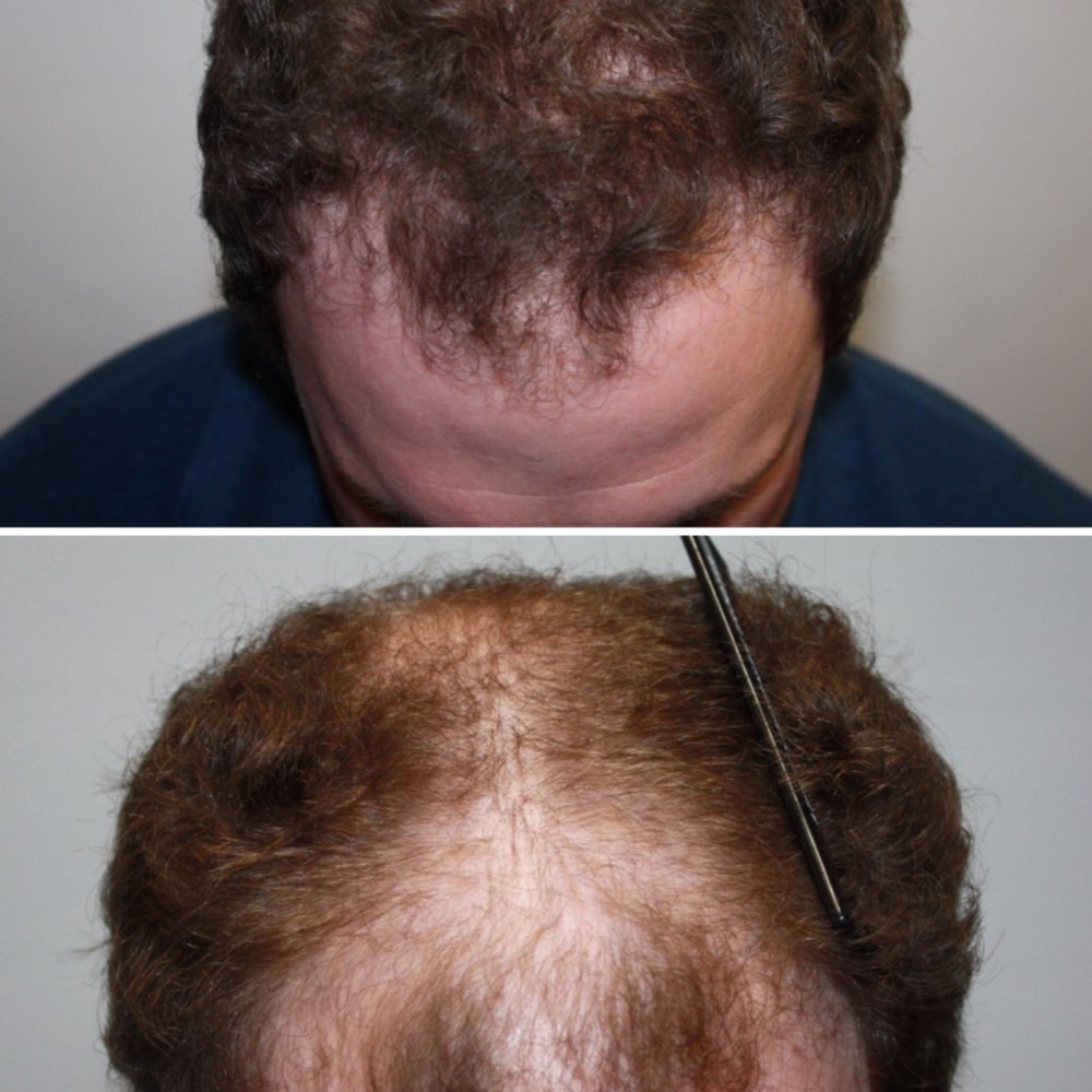 Hair Transplant Elk Grove California