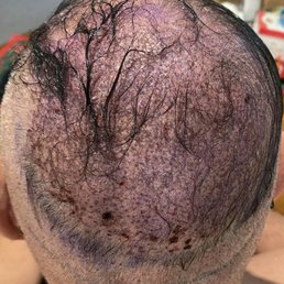 Hair Transplant Elk Grove California