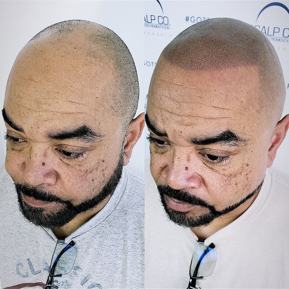Hair Transplant Elk Grove California