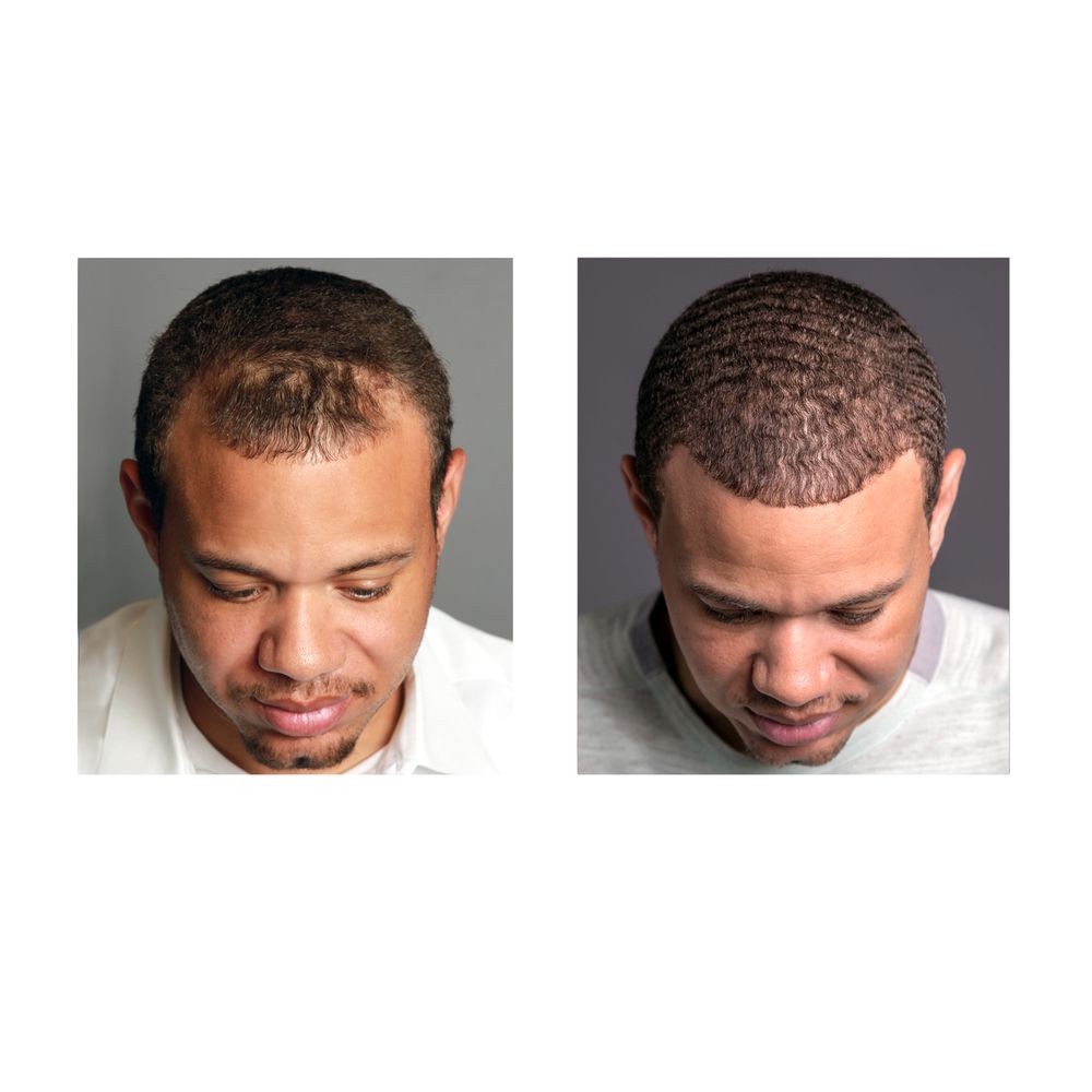 Hair Transplant Elk Grove California