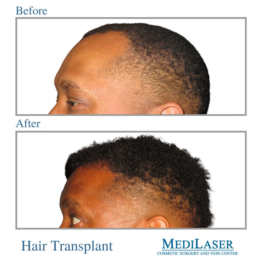 Hair Transplant Frisco Texas