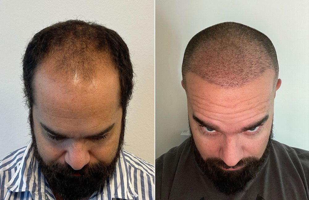 Hair Transplant Frisco Texas
