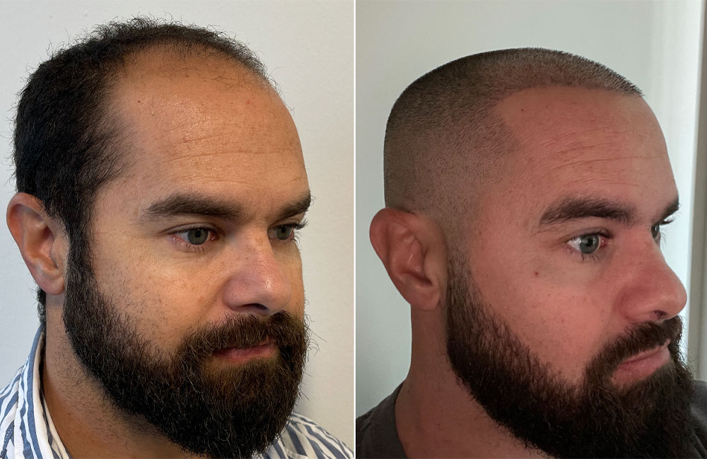 Hair Transplant Frisco Texas