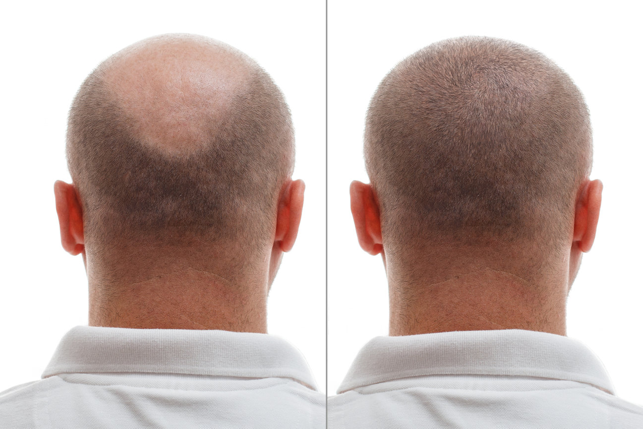 Hair Transplant Frisco Texas