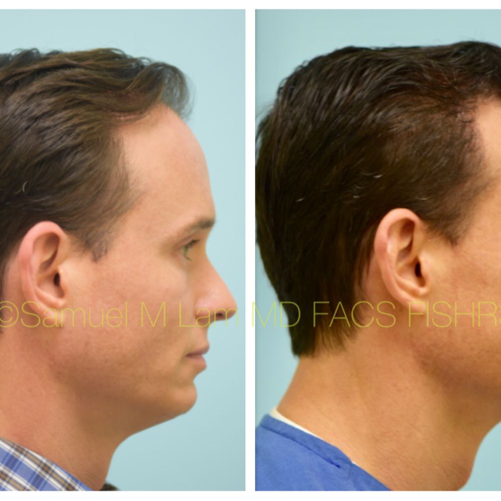 Hair Transplant Irving Texas