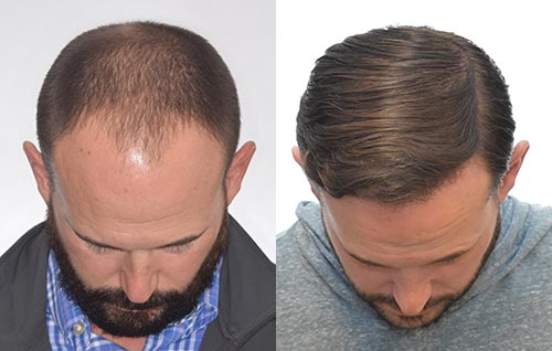 Hair Transplant Jackson Mississippi Hair Transplant Jackson Mississippi