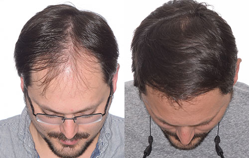 Hair Transplant Jackson Mississippi Hair Transplant Jackson Mississippi