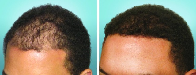 Hair Transplant Jackson Mississippi Hair Transplant Jackson Mississippi