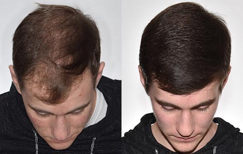 Hair Transplant Jackson Mississippi Hair Transplant Jackson Mississippi
