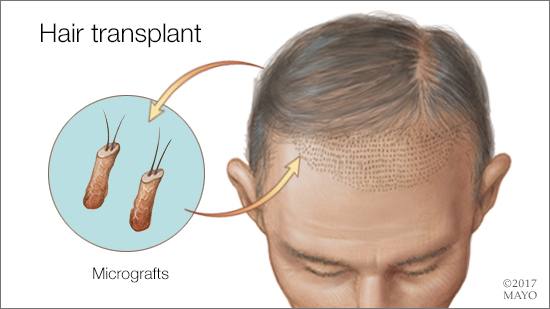 Hair Transplant Rochester Minnesota