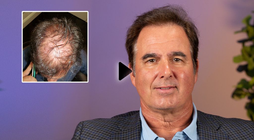 Hair Transplant Roswell Georgia