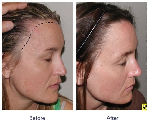 Hair Transplant St. Paul Minnesota