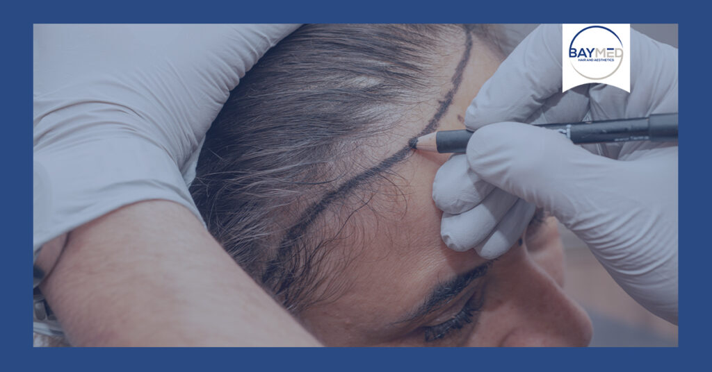 Hair Transplant St. Petersburg Florida Hair Transplant St. Petersburg Florida