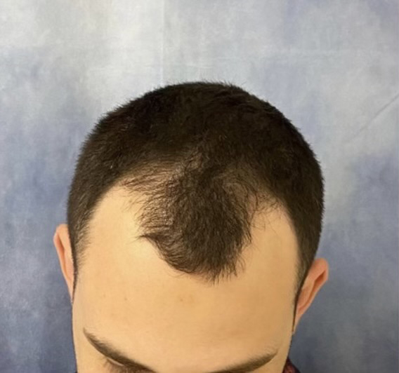Hair Transplant St. Petersburg Florida Hair Transplant St. Petersburg Florida