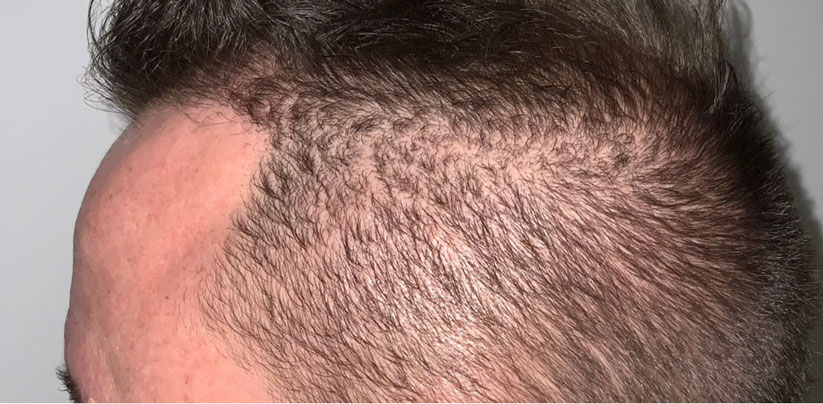 Hair Transplant St. Petersburg Florida Hair Transplant St. Petersburg Florida