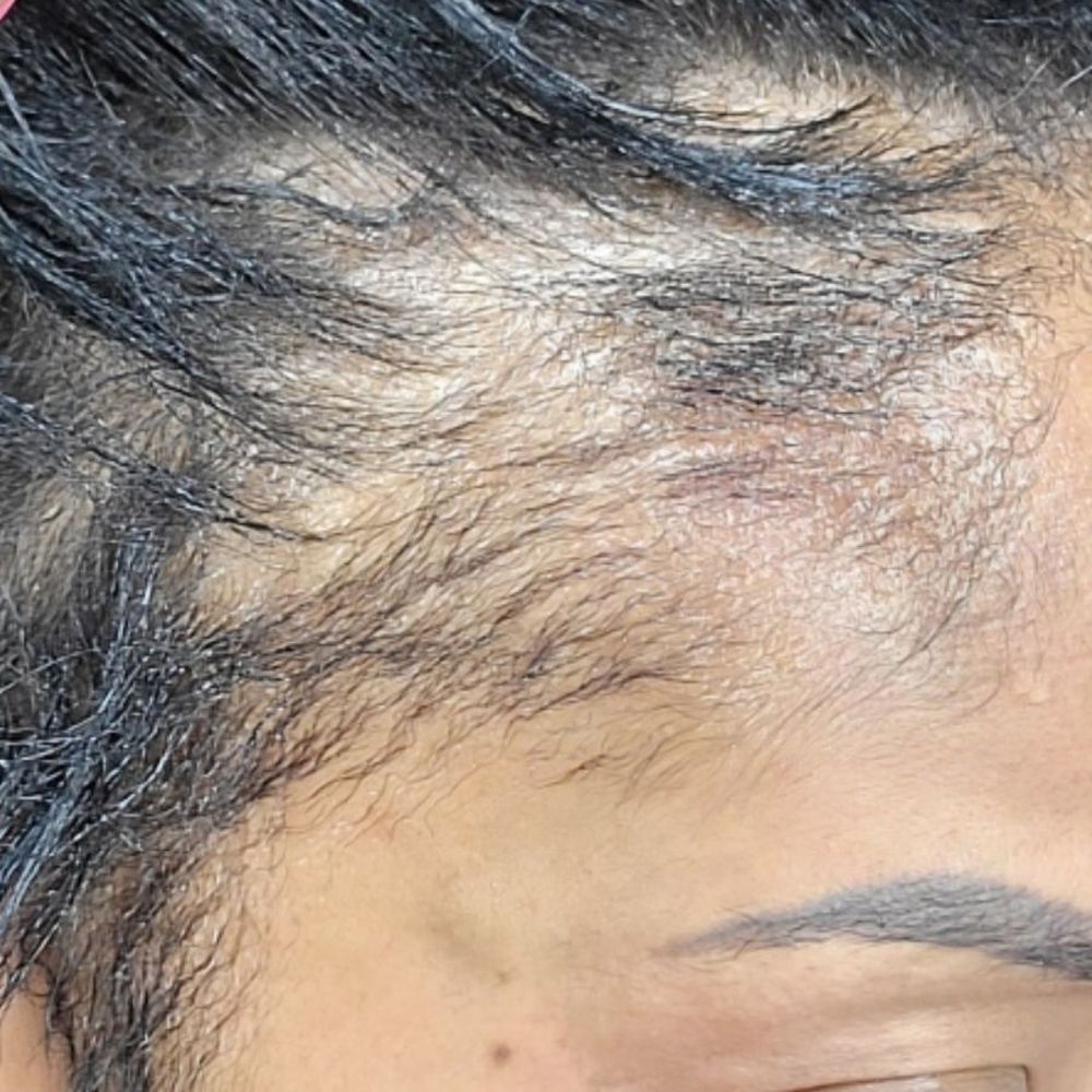Hair Transplant Calumet City Illinois