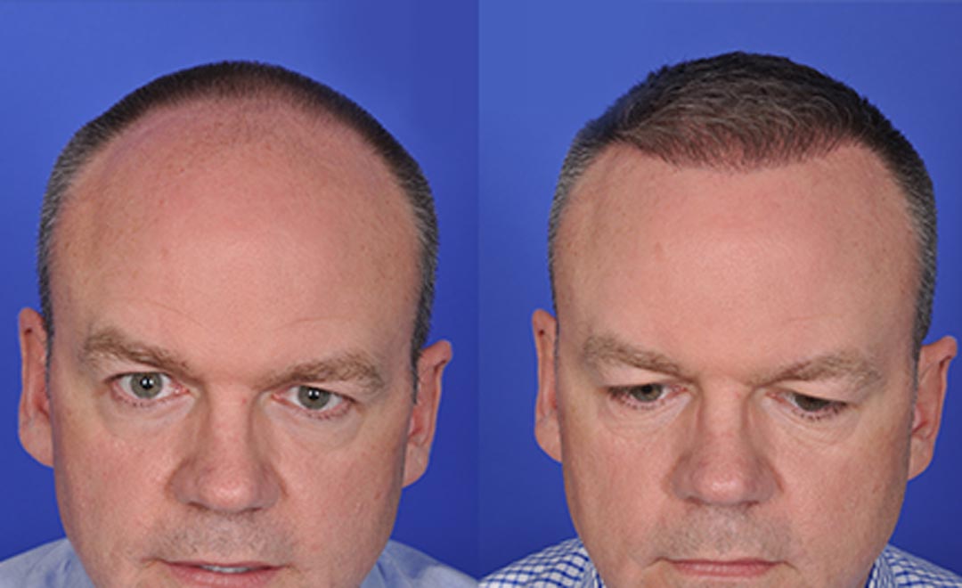 Hair Transplant Calumet City Illinois