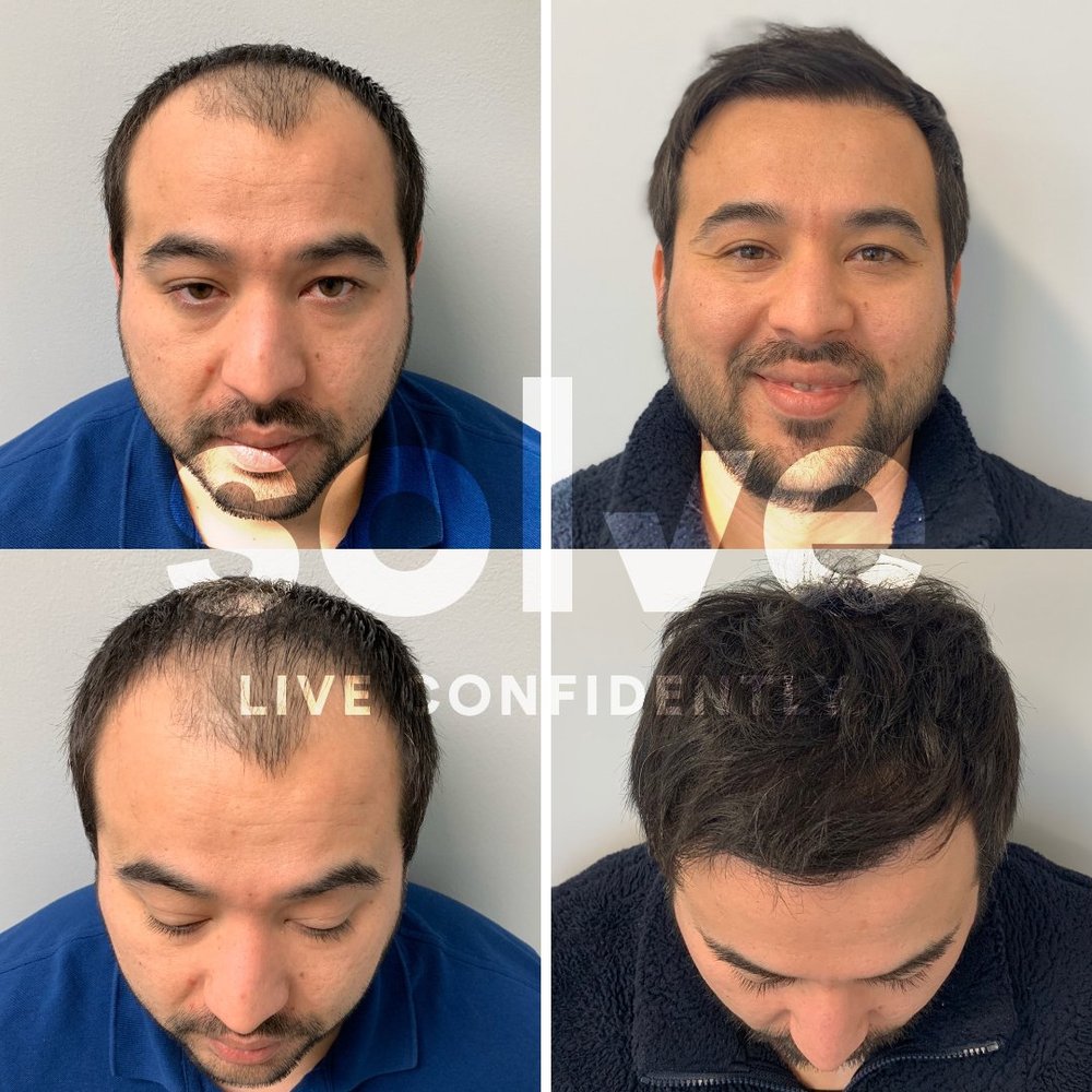 Hair Transplant Cicero Illinois