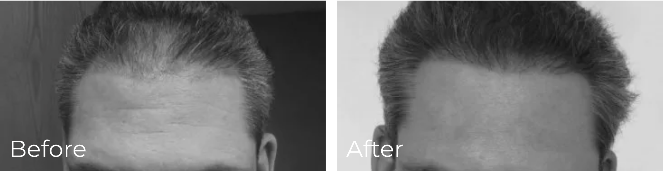 Hair Transplant Cicero Illinois