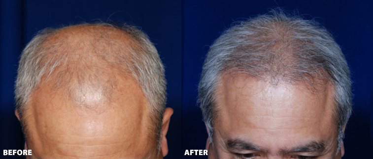 Hair Transplant Danville California