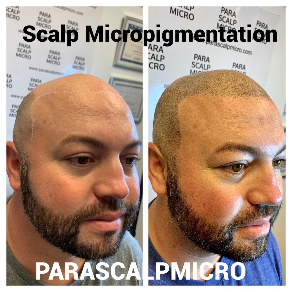 Hair Transplant Hackensack New Jersey