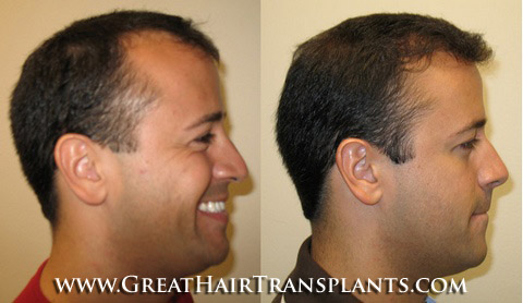 Hair Transplant Meridian Idaho
