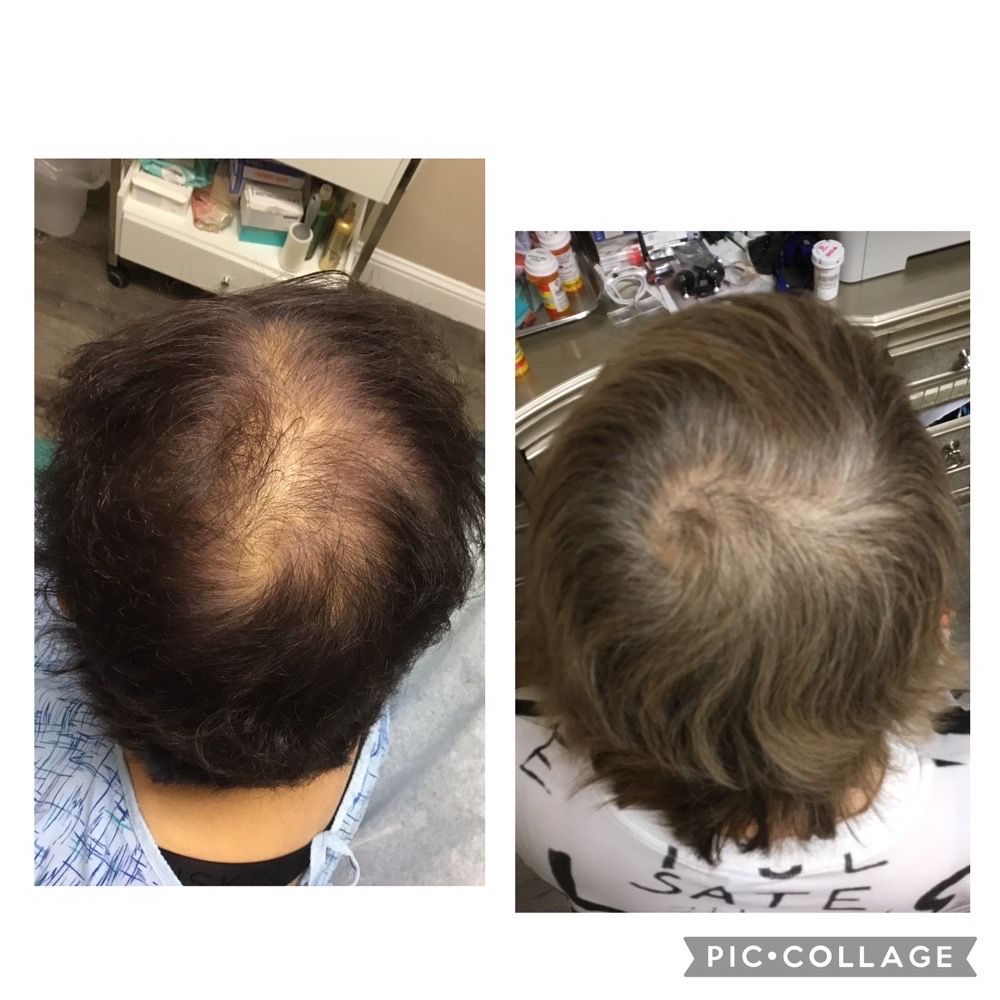 Hair Transplant Newark California Hair Transplant Newark California