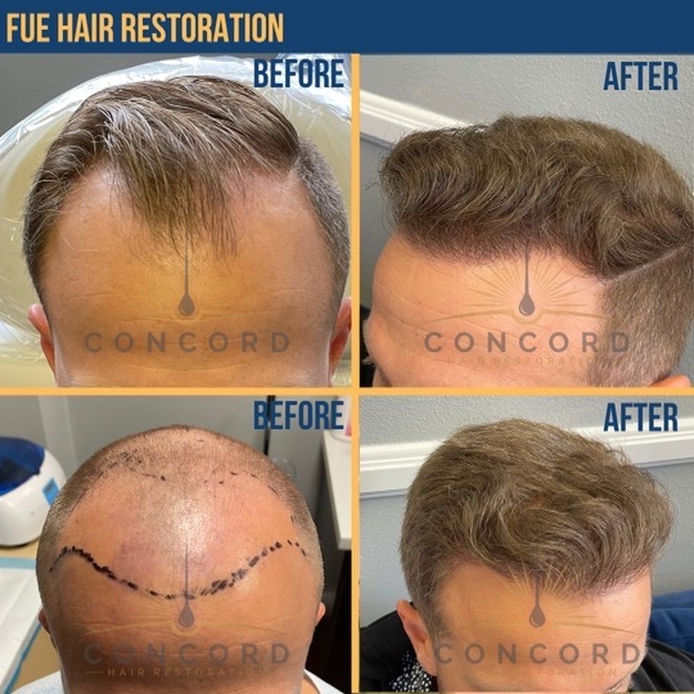 Hair Transplant Stanton California