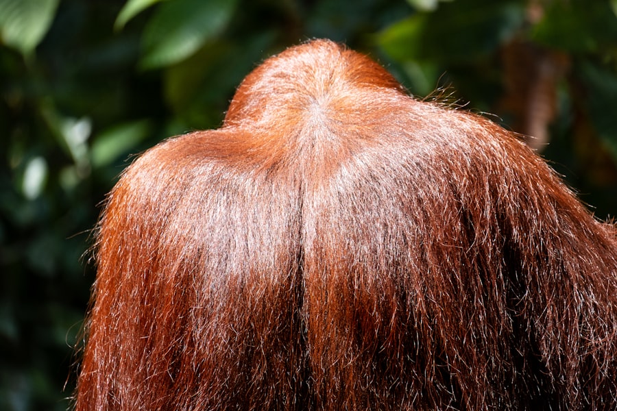 Hair Transplant Results