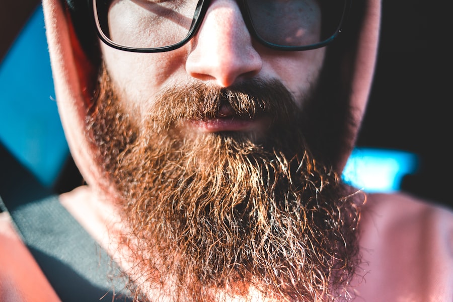 Photo Beard Transplant