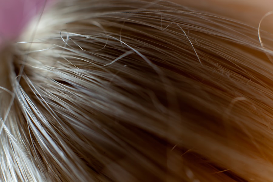 Photo Microneedling Hair Restoration